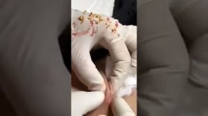 ПОЛНОЕ удаление прыщей в зоне подмышек - Часть 7  #прыщи #угри #угреваясыпь #удалениепрыщей