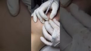 Эффективное удаление и лечение подкожных прыщей (милиумов) и черных точек.