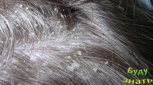 Вши и Перхоть КАК РАЗЛИЧИТЬ?