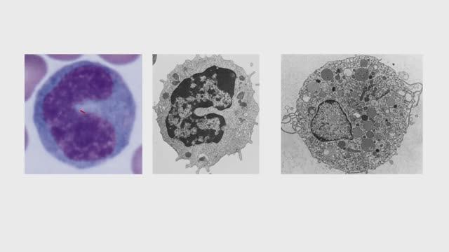 Хроническое воспаление. (Блок 3. Лекция 4)
