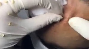 СУПЕР удаление кистозных акне на лбу. - Часть 3. #акне #постакне #механическаячистка