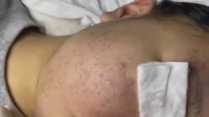 Выдавливание прыщей. Новое видео для расслабления #114. #прыщи #угри #угреваясыпь #удалениепрыщей