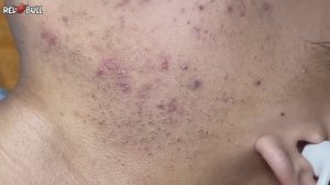 Прыщ-хамелеон. Казался простым, но оказался... #𝟗𝟎𝟎𝟑𝟕𝟑