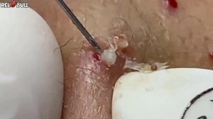 Вы не поверите, что было внутри. Вскрытие подкожного узла. #𝟗𝟎𝟎𝟑𝟗𝟐