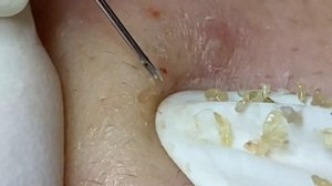 Relax Acne 001 • АСМР • Loan Nguyen collection