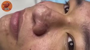 Прыщ, взорвавшийся под давлением. Катастрофа или катарсис? 𝟗𝟎𝟎𝟑𝟖𝟒