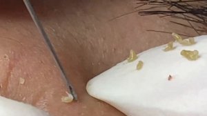 Relax Acne 004 • АСМР • Loan Nguyen collection