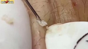 Секретное оружие против черных точек, которое скрывают косметологи. 𝟗𝟎𝟎𝟑𝟖𝟒