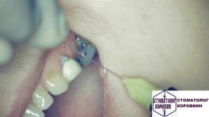 Инфильтрационная анестезия в области 24-27 для экстракции 26  и имплантации 25 и 26.