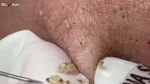 Выдавливание чёрных точек без кровотечения. Расслабление 𝟗𝟎𝟎𝟑𝟖𝟎. #черныеточки #чисткалица