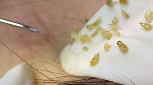 Relax Acne 010 • АСМР • Loan Nguyen collection