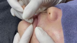 Relax Acne 003 • АСМР • Loan Nguyen collection