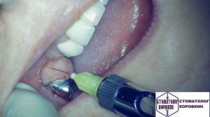 инфильтрационная анестезия для имплантаци 14,15.