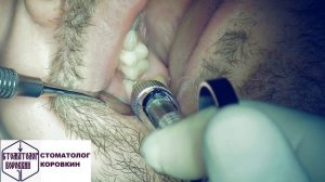 Инфильтрационная анестезия для имплантации 16.