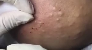 Удаление тяжелых форм акне. Лечение кистозных прыщей. #лечениеакне #кистозныепрыщи #тяжелоеакне