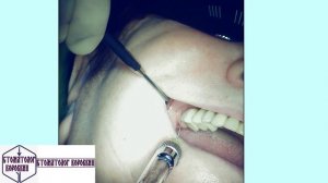 Инфильтрационная анестезия в области имплантации 17.