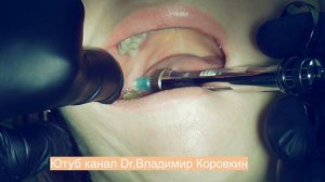 Проводниковая анестезия Для лечения  48.