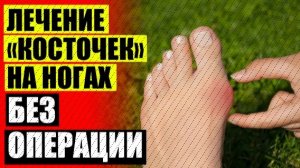 Болят косточки на ногах возле большого ⚠ Как лечить косточки на ногах отзывы