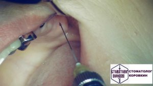 Инфильтрационная анестезия  для имплантации в области 27.