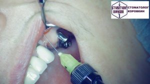 Инфильтрационная анестезия для имплантации 26.