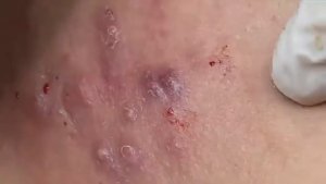 Сложный случай лечения угревой болезни. #тяжелоеакне #лечениеакне #угреваяболезнь