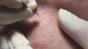 Лечение подкожных прыщей (угрей). #лечениеподкожныхпрыщей #подкожныеугри