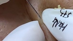 Relax Acne 020 • АСМР • Loan Nguyen collection