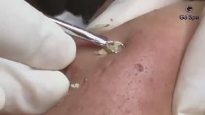 Черные точки и акне на лице: как избавиться, выдавливание черных точек.