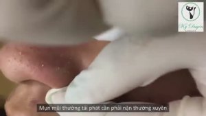 Лечение твердых желтых сальных пробок (милиумов/комедонов) на носу