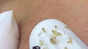 Relax Acne 014 • АСМР • Loan Nguyen collection