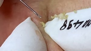 Relax Acne 018 • АСМР • Loan Nguyen collection