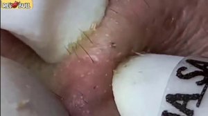 Удаление черных точек. асмр прыщи. Для расслабления. 𝟗𝟎𝟎𝟑𝟖𝟕 #черныеточки #чисткалица