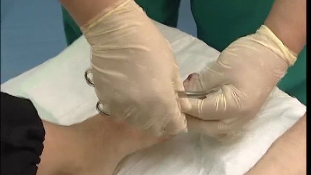 Вросший ноготь смотреть онлайн