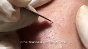 Лечение тяжелой формы подкожных прыщей у 20-летней девушки