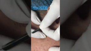 Лечение черных точек и закрытых комедонов (подкожных прыщей) #черныеточки #лечениеакне