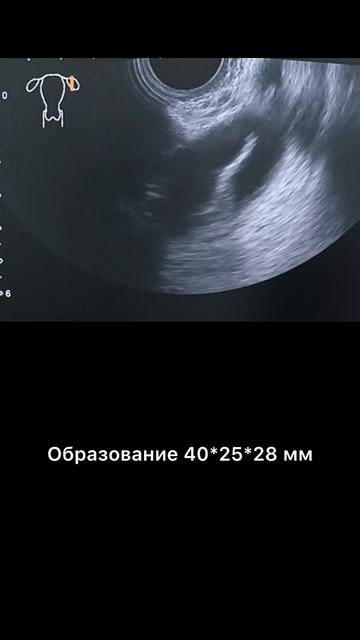 #гидросальпингс