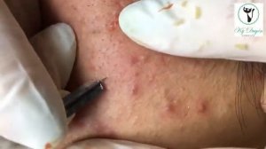 Лечение скрытых (подкожных) прыщей: опасность и непредсказуемость.