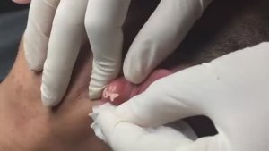 Лечение самых ужасных в мире кистозных угрей, «паразитирующих» на коже человека