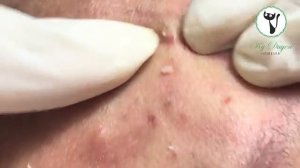 Лечение тяжелой формы черных точек. #тяжелыечерныеточки #лечениеакне