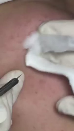 Лечение черных точек — Часть 1 #черныеточки #лечениеакне #проблемнаякожа