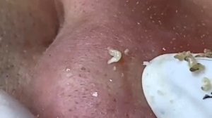 Relax Acne 024 • АСМР • Loan Nguyen collection