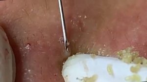 Relax Acne 023 • АСМР • Loan Nguyen collection