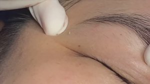 Удаление прыщей, скрытых под кожей (подкожных прыщей). #подкожныепрыщи #удалениеакне #глубокиеугри