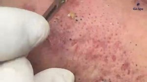 Полное видео выдавливания черных точек — Часть 1