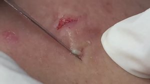 Огромные подкожные прыщи на лбу. #подкожныепрыщи #кистозныеугри #проблемнаякожа #лечениеакне