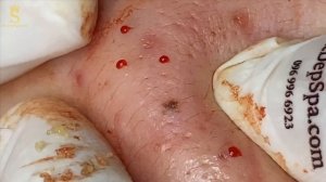 Гематомные прыщи (кровяные кисты) на щеках и лбу. #гематомныепрыщи #тяжелыйакне #лечениеакне