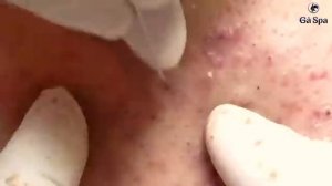 згляните на черные точки на левой щеке и на то, как мы их лечим. #черныеточки #лечениеакне #щека