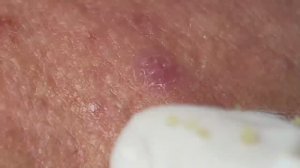 Огромные черные точки, скрытые глубоко под кожей. #удалениекомедонов #чисткалица #проблемнаякожа