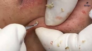 Полное видео выдавливания черных точек — Часть 3