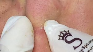 Белые и черные точки (комедоны): ПОЛНАЯ чистка и удаление! #черныеточки #белыеточки #комедоны